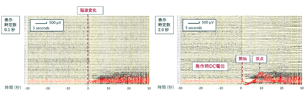 発作時DC電位とは