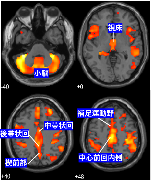 拒食症患者で健常女性に比べて灰白質量が減少している脳部位