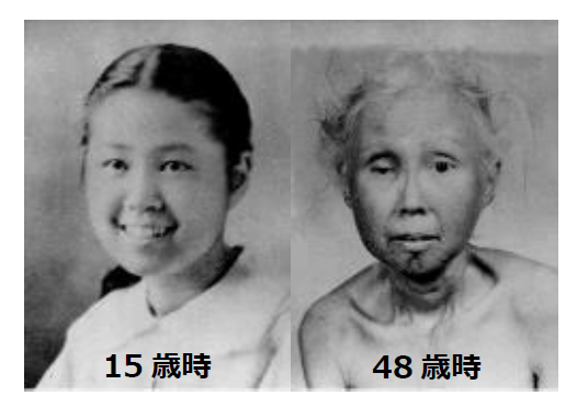 ウェルナー症候群の症例 (患者様とワシントン大学の許可を得て掲載）